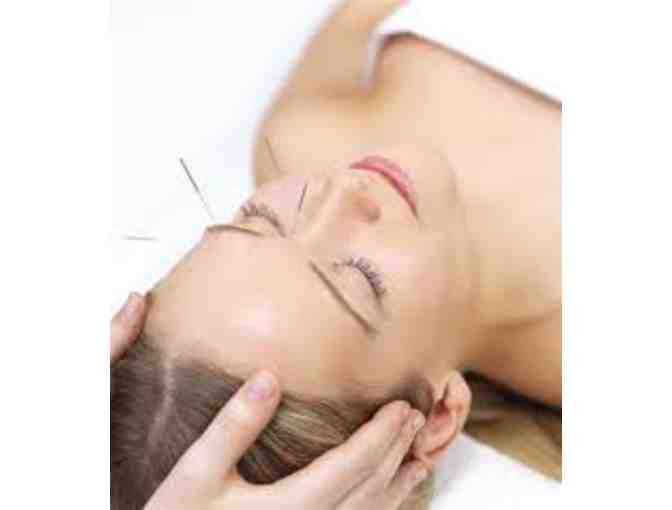 Newbury Park Acupuncture Session