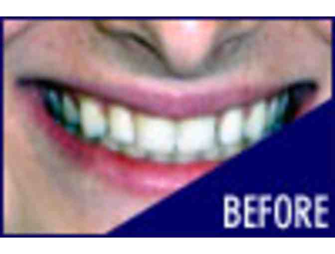 Boost in Office Whitening by Dr. David W. Epstein