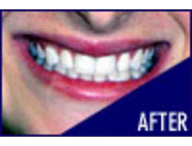 Boost in Office Whitening by Dr. David W. Epstein