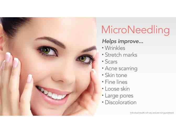 Microneedling/ Collagen Induction Therapy Session - Photo 1