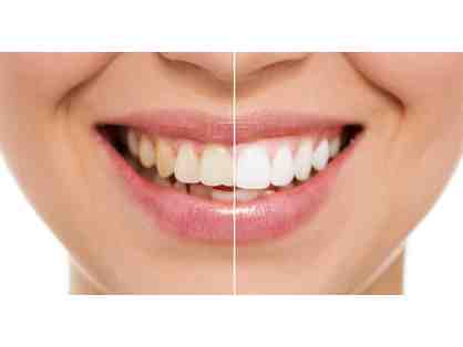 Professional Teeth Whitening