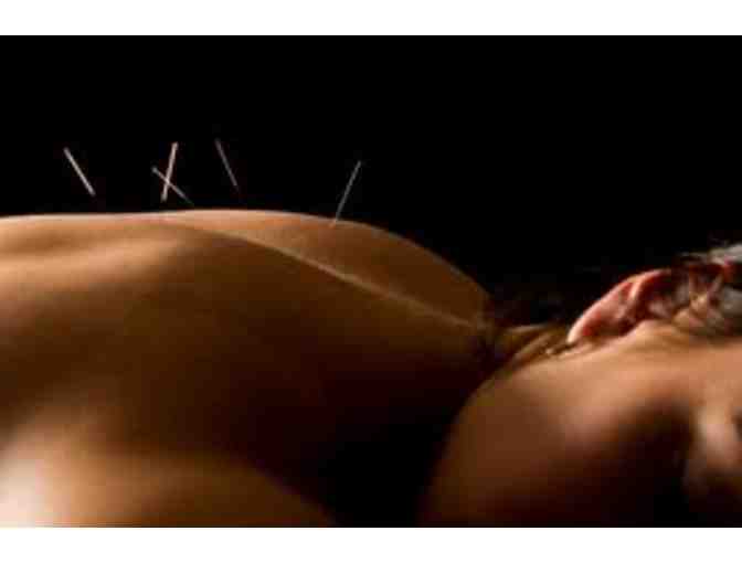 Acupuncture Session with Cal Millar, MS, L.Ac., Dipl. Ac. and C.H. (NCCAOM)