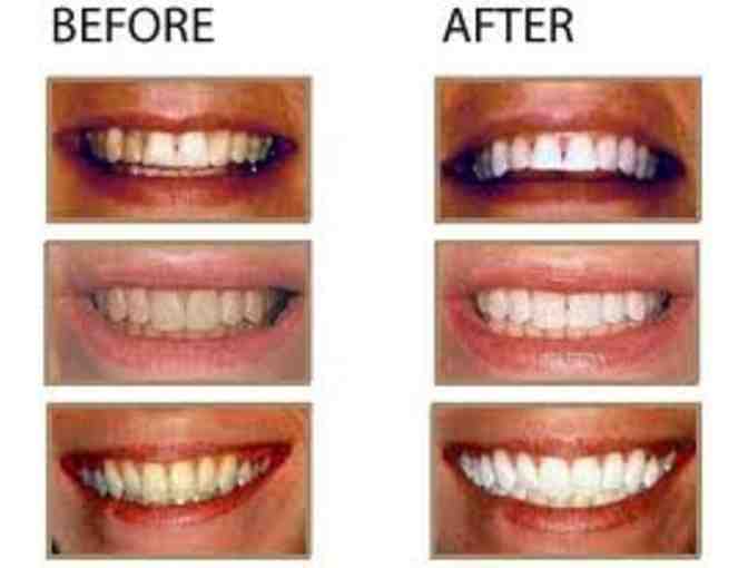 Chairside Tooth Whitening - Riverdale