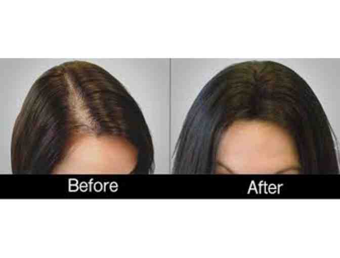 PRP Hair Restoration & Treatment at Longevity Medical Institute