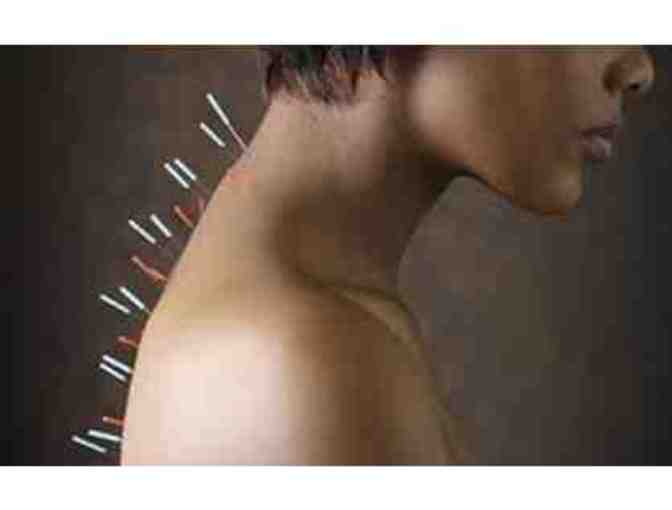Acupuncture Consultation and Treatment with Doc Mitchell, LAc.