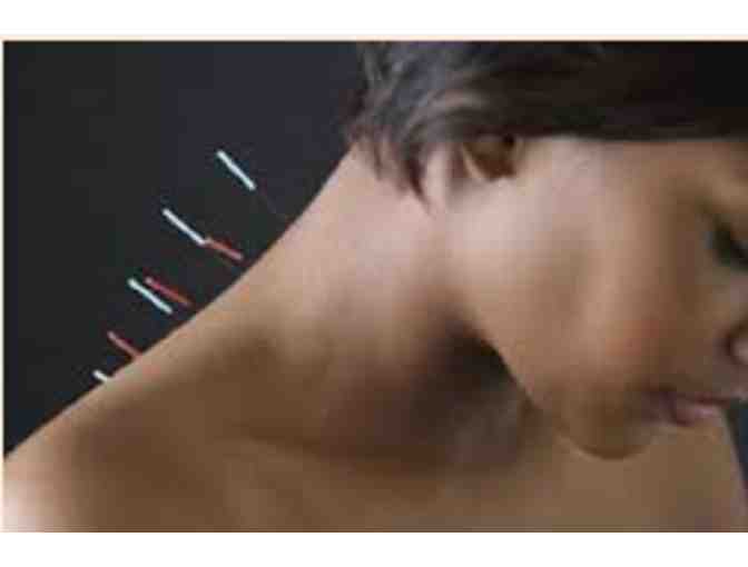Acupuncture Treatment